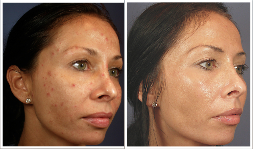 VI PEEL BEST CHEMICAL PEEL AUSTIN