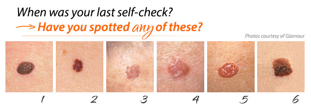 How To Recognize Melanoma