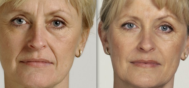 Cosmetic Fillers & Facial Rejuvenation