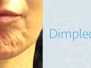 BOTOX FOR DIMPLED CHIN