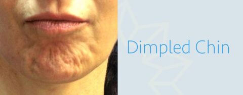 BOTOX FOR DIMPLED CHIN