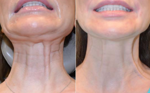 Neck Lift Botox Austin