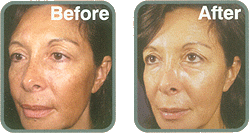 VI PEEL BEST CHEMICAL PEEL AUSTIN