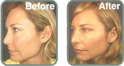 VI PEEL BEST CHEMICAL PEEL AUSTIN