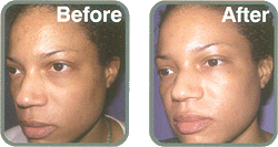 VI PEEL BEST CHEMICAL PEEL AUSTIN