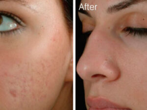 Austin: Help for Acne Scarring