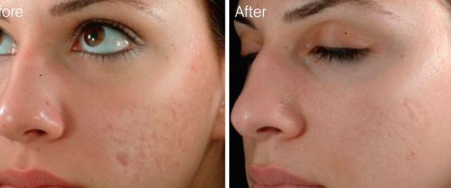 Austin: Help for Acne Scarring