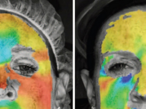 Botox Injections As Wrinkle Treatment: Heat Maps Show Efficacy Of Toxin Via 3D Imaging Technique