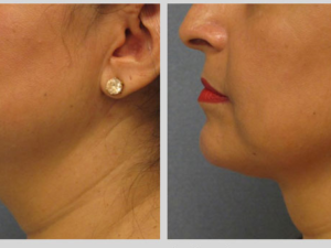 Non-Surgical Options for the Aging Neck