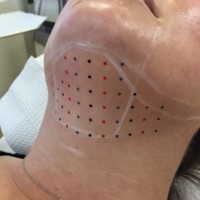 Kybella_Austin_Grid