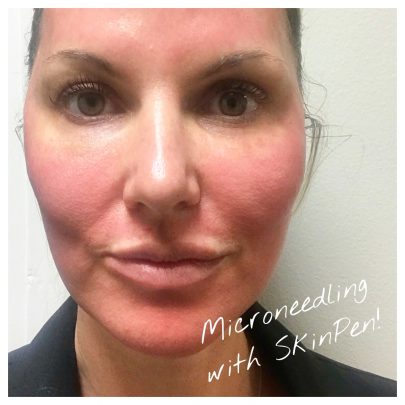 COLLAGEN INDUCTION THERAPY MICRONEEDLING