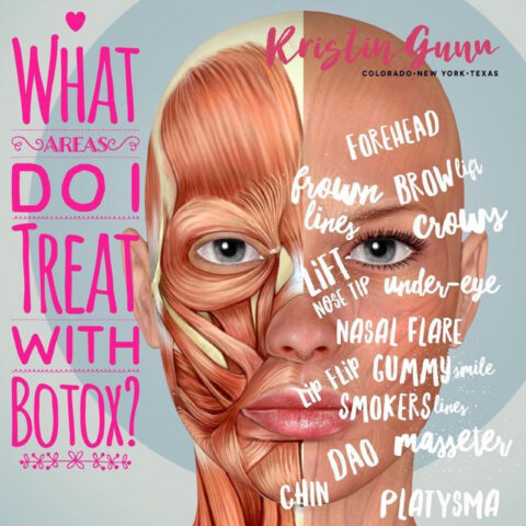 WHAT AREAS CAN I TREAT WITH BOTOX